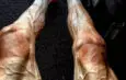 Visible Veins: Pathological, Natural, or Doping?