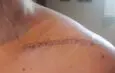 Broken collarbone
