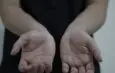 Carpal tunnel syndrome