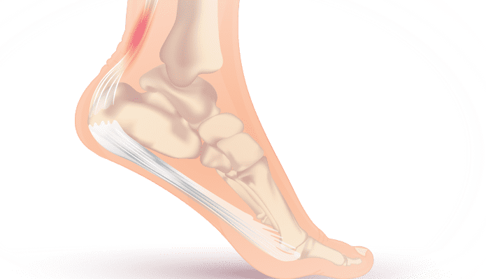 La tendinite du tendon d'Achille